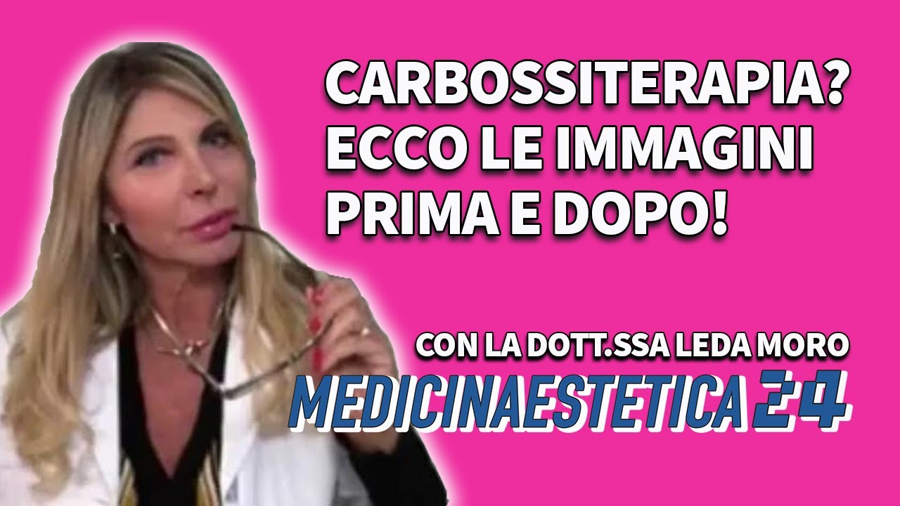 Watch Now CARBOSSITERAPIA PRIMA E DOPO: Ecco le immagini! Parliamo di Carbossiterapia con la Dr.ssa Leda Moro CARBOSSITERAPIA PRIMA E DOPO: Ecco le immagini! Parliamo di Carbossiterapia con la Dr.ssa Leda Moro