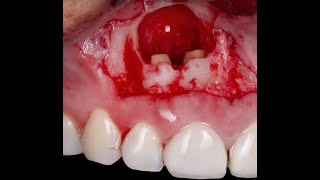 How to drain a dental abscess-Short video (Dr Shihab Romeed)