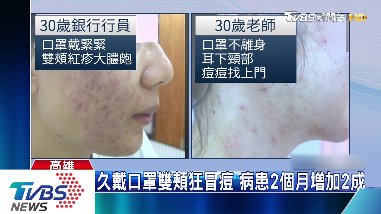 新冠肺炎長時間戴口罩 醫護人員變大花臉