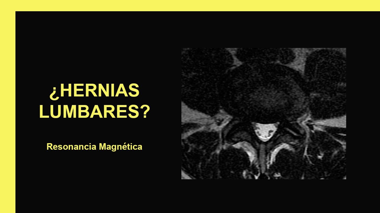 Hernias lumbares - Resonancia Magnética