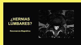 Hernias lumbares - Resonancia Magnética