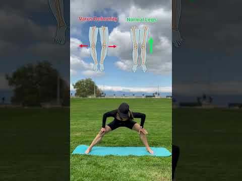 Correct valgus knees with this simple exercise! #valgus #knockknees #legalignment #legexercises