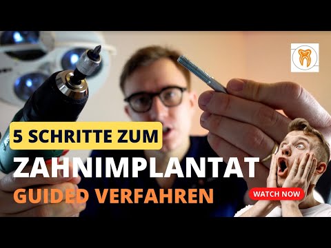 Zahnimplantate - 5 Schritte einer Implantattherapie und der Vergleich zum Guided Verfahren