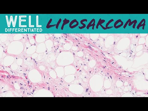 Well differentiated liposarcoma aka atypical lipomatous tumor (pathology sarcoma soft tissue tumor)