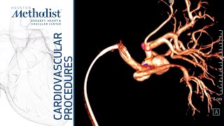 Download Lagu Endovascular Treatment of a Renal Artery Aneurysm (Alan B. Lumsden, MD, M. Mujeeb Zubair, MD) Thumbnail