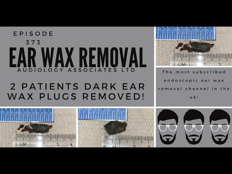 2 PATIENTS DARK EAR WAX PLUGS REMOVED   EP 373