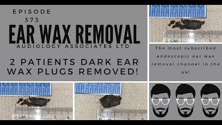 2 PATIENTS DARK EAR WAX PLUGS REMOVED   EP 373