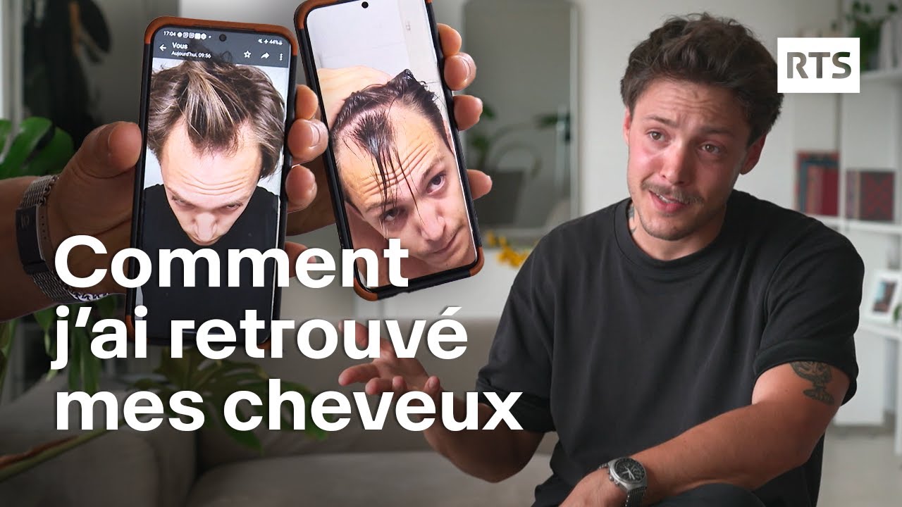 Les greffes de cheveux séduisent de plus en plus face à la calvitie | RTS