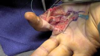 Zone 2 Flexor Tendon RepairZone 2 Flexor Tendon Repair