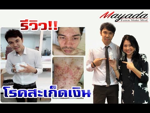กลากภาพแรกเกิด กลากทั้งทำความสะอาดร่างกาย