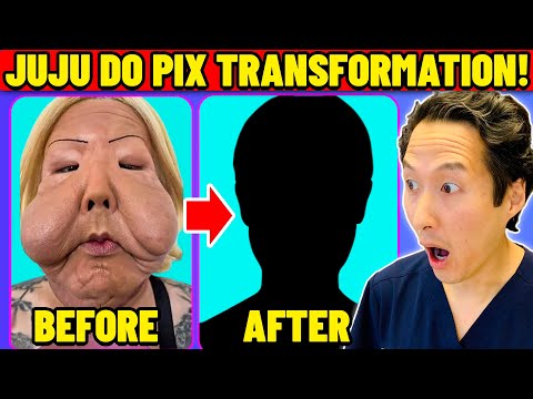 整形失敗還有救嗎？網紅慘遭密醫毀容後的高難度臉部重建手術 (JuJu Do Pix Gets Corrective Plastic Surgery! Extreme Bodies Explained!)