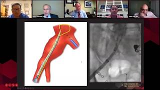 Download Lagu Dr. Darren Schneider presents Revision of Failing EVAR Thumbnail