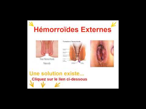 comment appliquer suppositoire