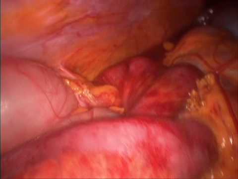comment traiter occlusion intestinale