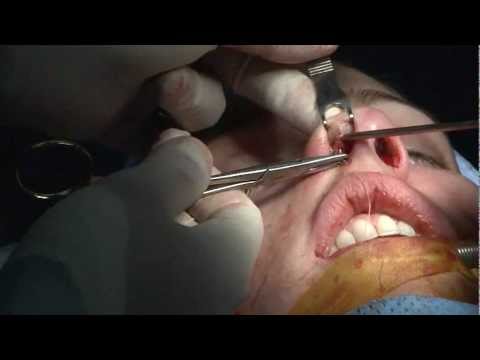 Rhinoplasty