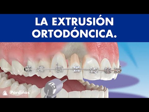 Extrusión ortodóncica ©