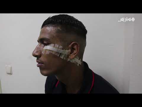 التشرميل في فاس.. لص يعترض طريق طالب ويشوه وجهه بسلاح أبيض