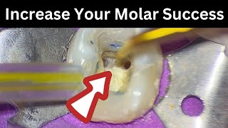Should You Trough Mandibular Molars?