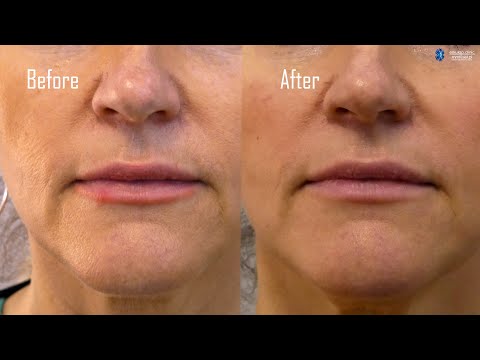 Collagen and PRP injections Before and After - Eskulap Beauty News