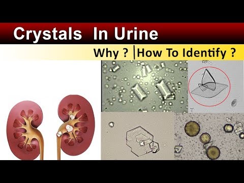 Crystals In Urine  ( Why & How to Identify ? )