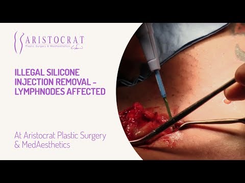 Illegal Silicone Injection Removal- Lymphnodes Affected