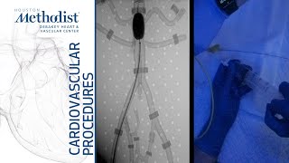 Download Lagu Endovascular Balloon Control of Aorta During RAAA with Hypotension (M. Rahimi, MD; M. Berczeli, MD) Thumbnail