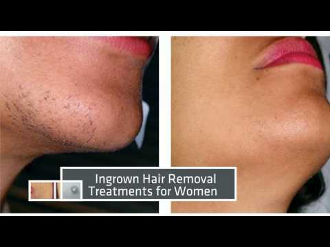 Laser Hair Removal Miami :: Before & After Results