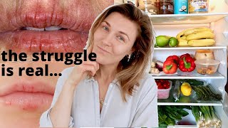 Eczema on the Lips - What Foods to Eat and Avoid When You Have Angular Cheilitis or Lip Eczema