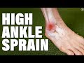 High Ankle Sprain | Syndesmosis Injury (Evaluation | Education | Exercises)