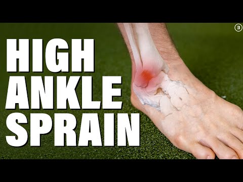 High Ankle Sprain | Syndesmosis Injury (Evaluation | Education | Exercises)