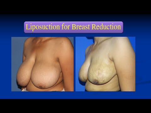 Breast Reduction Surgery