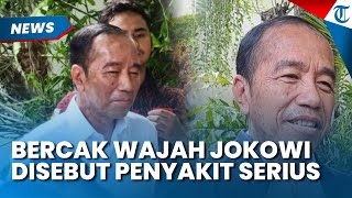 BERCAK WAJAH JOKOWI Disebut Penyakit Serius, Ajudan Ungkap Penyebabnya