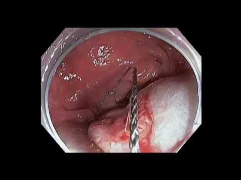 EMR: Snare Margin Cut of a Depressed Rectal Lesion