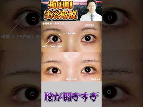 医学科 過矯正&幅狭修正 #うめだ美容外科クリニック #美容外科 #眼瞼下垂