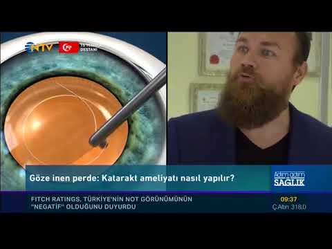 Op. Dr. Özer Kavalcıoğlu – NTV Adım Adım Sağlık – Akıllı Lens Tedavisi