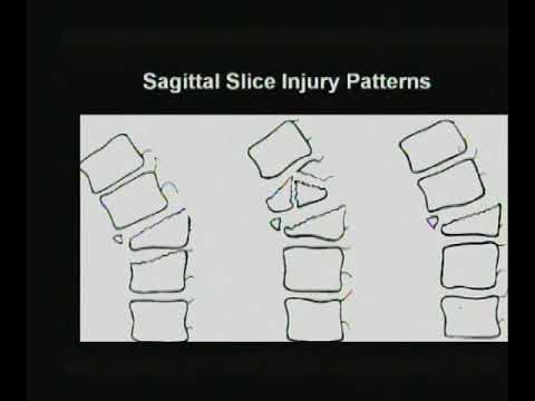New Trends in Imaging Thoraco Lumbar Spine Trauma