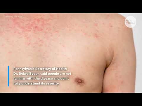 Two dead in Pennsylvania measles outbreak, first in US in 2026