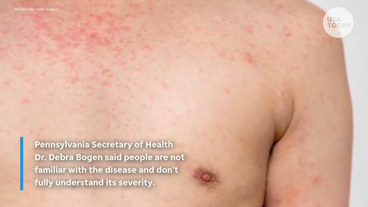 Two dead in Pennsylvania measles outbreak, first in US in 2026