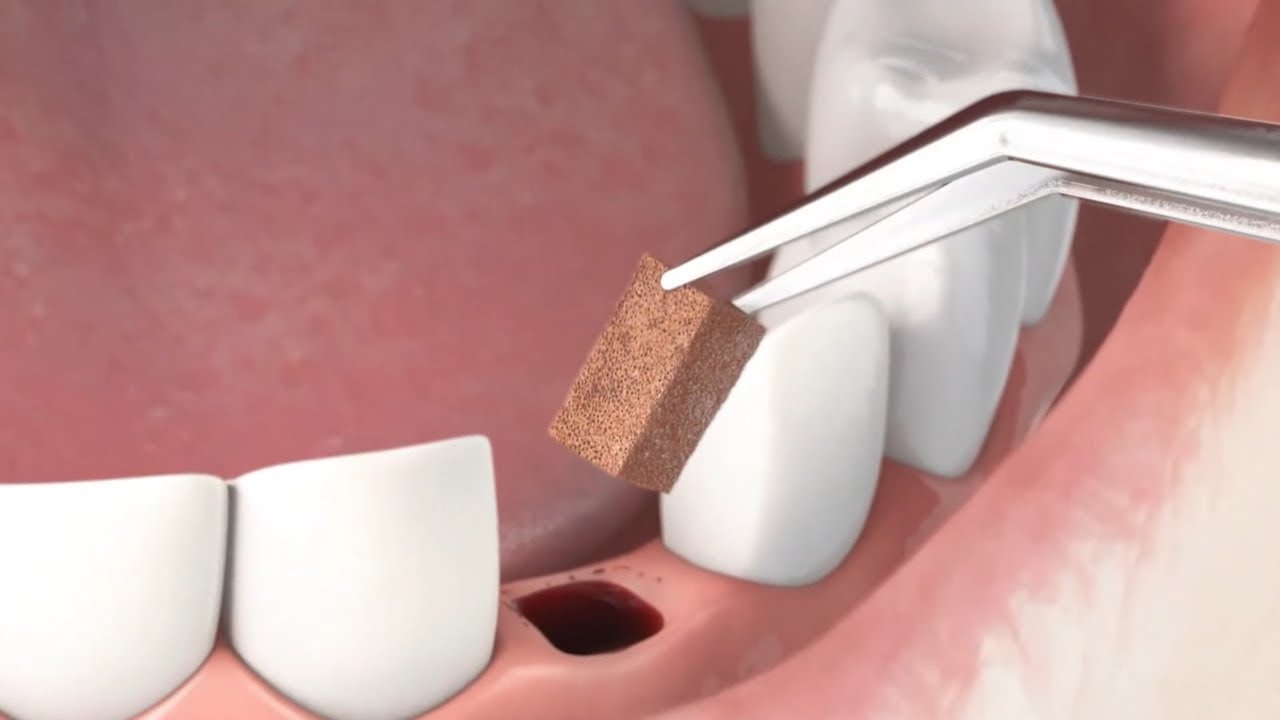 Explication Gelatamp Forte