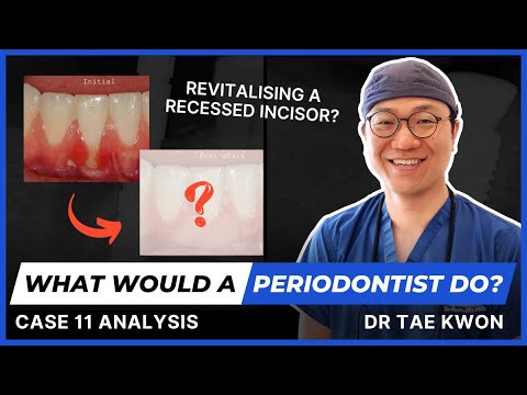 What Would A Periodontist do? With Dr Tae Kwon - Case 11