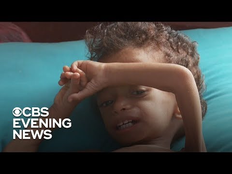 Time running out for starving children in Yemen
