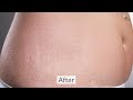 Stretch Mark Removal Cream Fixderma Strallium Stretch Marks Cream