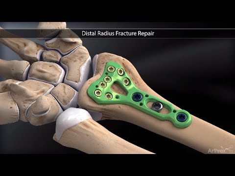 Distal Radius Fracture Repair