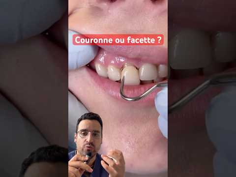 Veneer or crown: what’s the difference, and which one to choose?