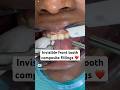 Got decay ? Invisible composite fillings ...Step by Step tutorial