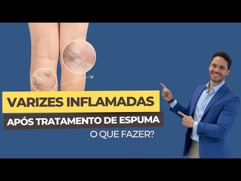 Varizes inflamadas após tratamento com espuma: o que fazer?