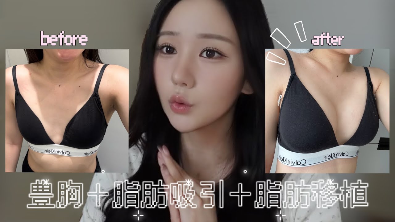 豊胸して半年経ったのでビフォーアフター公開‼️どこでした？やってよかった？全て話します🗣️💭