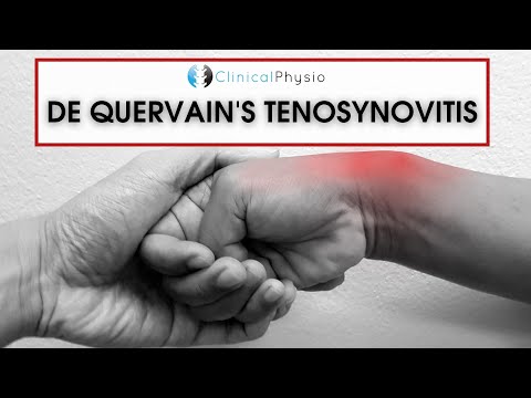 De Quervain's Tenosynovitis | What is it? How do you treat it?