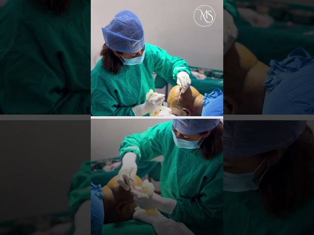 Hair Transplant Delhi