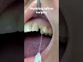 Numbing before implant surgery #implant #dentalimplants #numbing #shorts